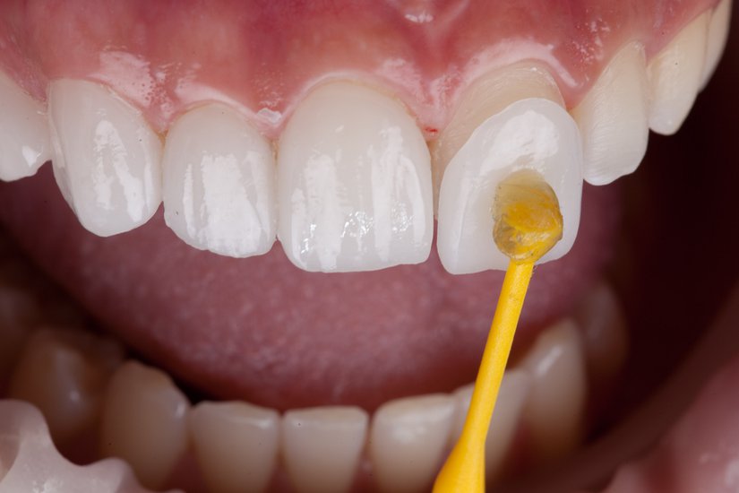 A Comprehensive Guide to Different Types of Dental Veneers