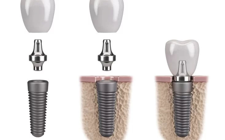 Dentakademi sheds light on the unparalleled benefits of opting for dental implants.
