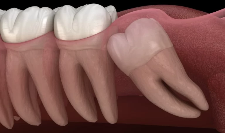Wisdom tooth extraction pain and recovery