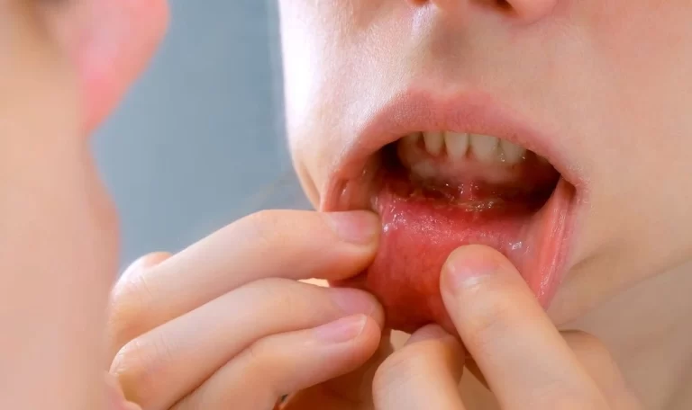 Oral cancer symptoms, causes, and treatments