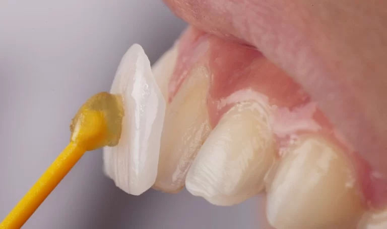 Veneer crown types, procedure, and benefits
