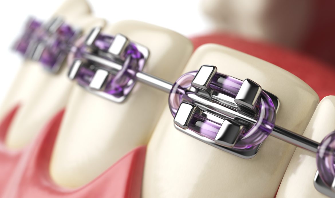 After braces are installed, teeth typically begin to move within 4-6 weeks, with noticeable improvements visible within 3-6 months.
