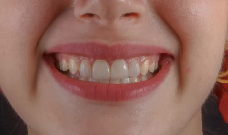 Gummy smile caused by short upper lip, excessive gum tissue, or small teeth.