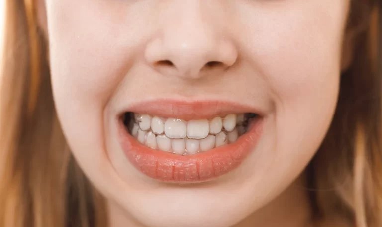 Teeth grinding usually stems from stress, sleep disorders, or bite problems.
