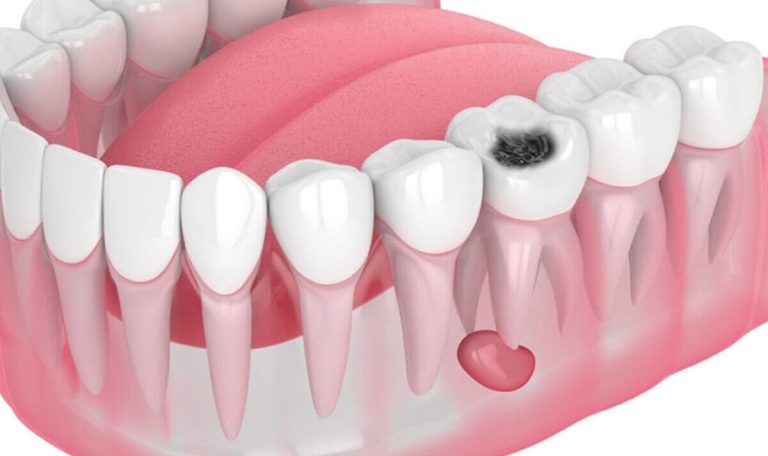 dental cyst