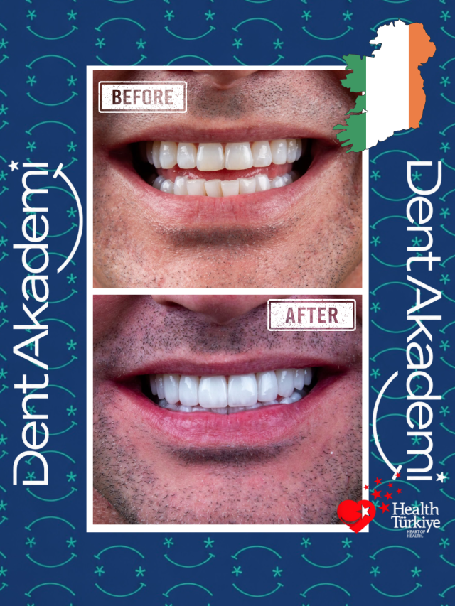 Porcelain Veneer-Istaanbul
